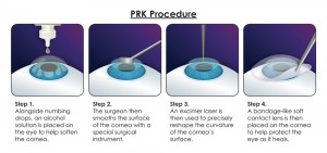 PRK Process